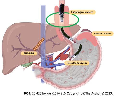 Endoscopic ultrasound-guided vascular interventions: An expanding paradigm