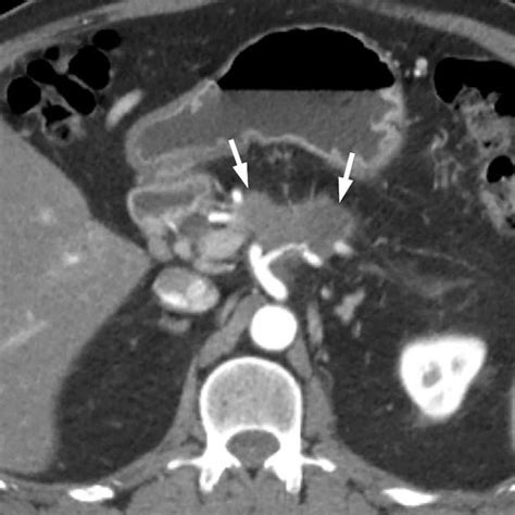 Image result for Normal DaTscan