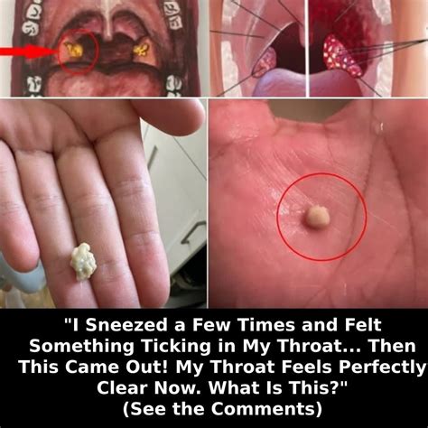 Tonsil Stones: The Complete Guide to Causes, Symptoms & Removal