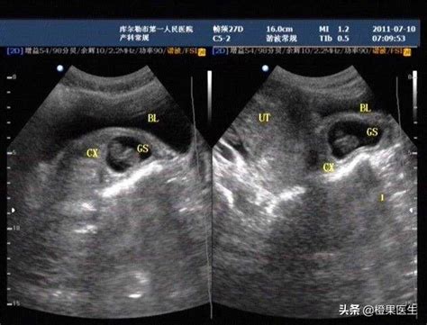 怀孕初期应注意什么注意事项大全 - 孕期检查 - 蓝灵育儿网