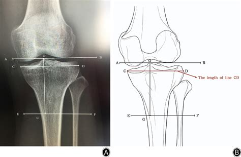 Proximal Tibia 的图像结果