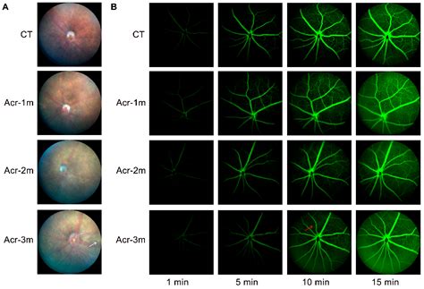 Acrolein Induces Retinal Abnormalities of Alzheimer’s Disease in Mice