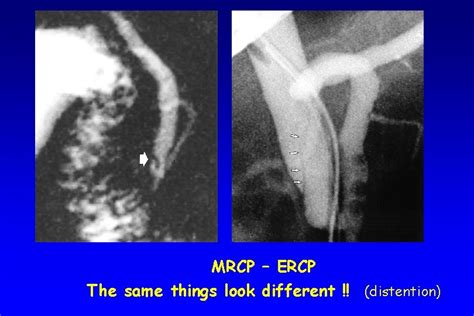 Image result for Abnormal MRCP