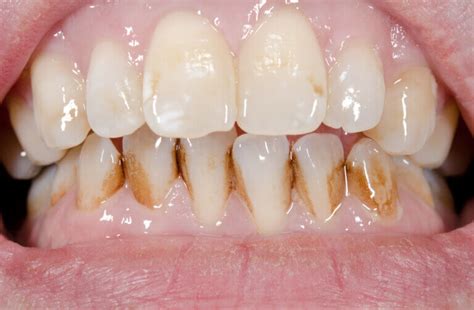 Image result for Teeth Staining Causes
