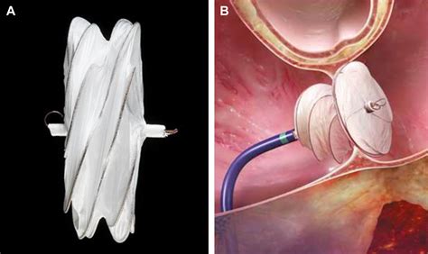 State-of-the-Art Atrial Septal Defect Closure Devices for Congenital Heart - Interventional ...