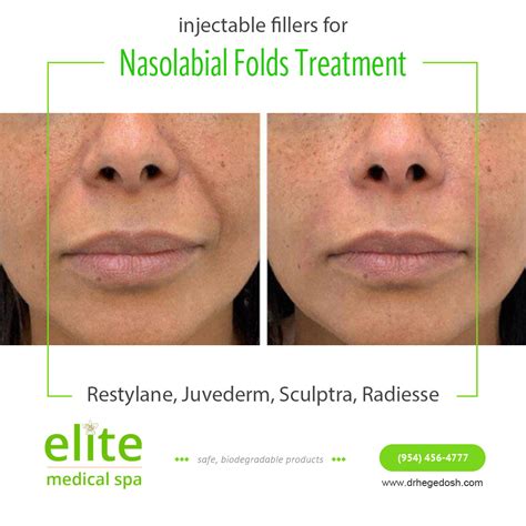 Nasolabial Folds Treatment