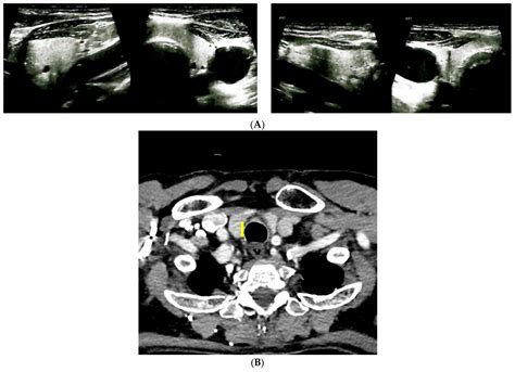 Paget’s Disease of Bone and Normocalcemic Variant of Primary ...