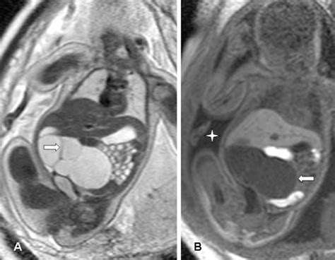 Ovarian cysts on prenatal MRI - European Journal of Radiology