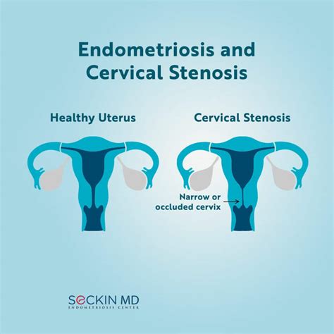 Cervical Dilators For Cervical Stenosis at Victoria Stead blog