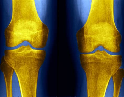 Label The X-Ray Of The Knee at Leroy Olson blog