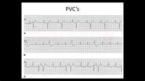 Image result for PVC ECG Reading