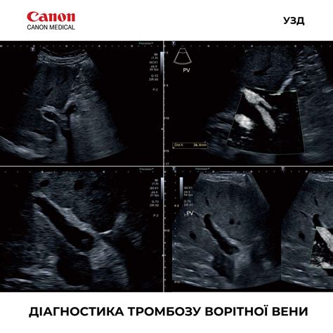 Діагностика тромбозу ворітної вени