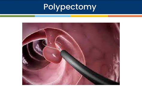 Image result for Polypectomy Recovery