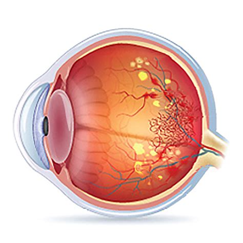 What is diabetic retinopathy? | Dr. Manisha Agarwal