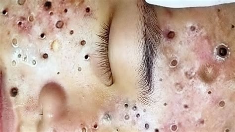 Image result for Largest Infected Exploding Cyst Carbuncle Blackhead