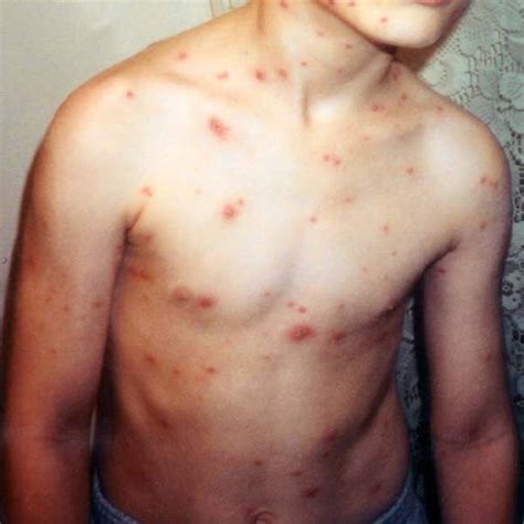 Measles Meaning In Hindi: खसरा क्या है? लक्षण, कारण और टीकाकरण गाइड