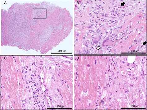 A case of giant cell myocarditis mimicking cardiac sarcoidosis successfully maintained by ...