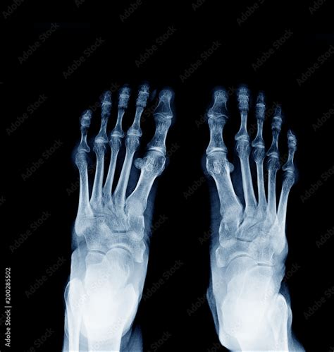 Normal Foot 的图像结果