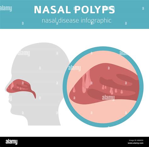 Nasal Polyps Causes Symptoms And Diagnosis