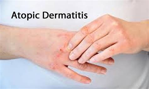 Dupilumab improves severe Atopic Dermatitis in children between 6 to 11 ...