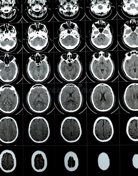 Image result for Normal Brain CT Scan