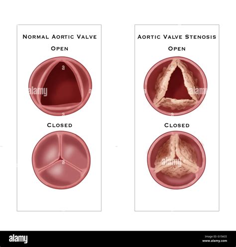 Illustration comparing a normal aortic valve (left) to aortic valve stenosis (right), a type of ...