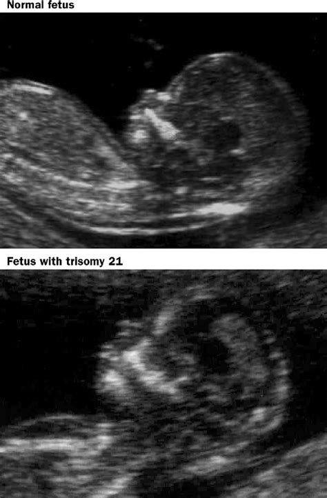 12 Week Ultrasound Down Syndrome