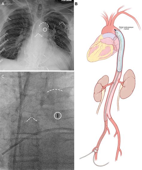 Radiology of Intra-Aortic Balloon Pump CathetersRadiology ...