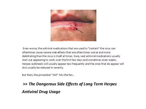 Herpes Symptoms In Men | PPTX