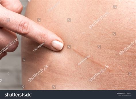 Image result for Appendix Surgery Scar