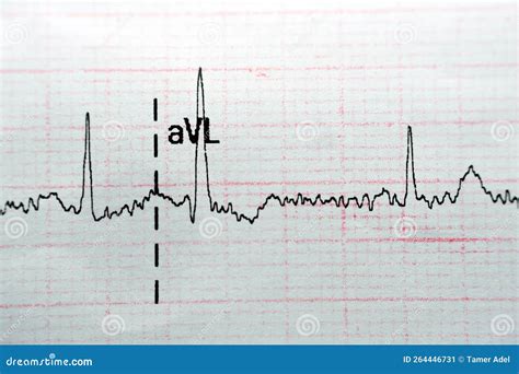 ECG ElectroCardioGraph Paper that Shows Normal Sinus Rhythm NSR with ...