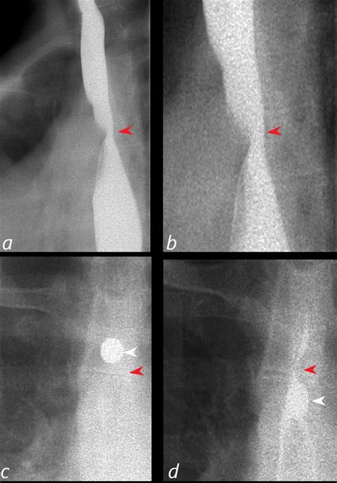 287Lu Aberrant Right Subclavian Artery and Dysphagia Lusoria | The Common Vein