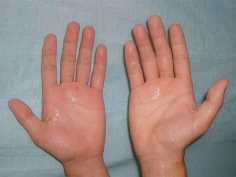 手汗症有效的治疗方式 - 知乎