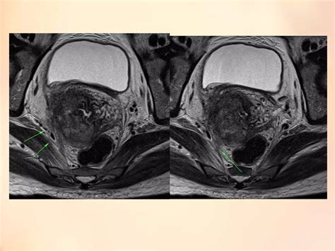 Urology gynecology mri staging for ca cervix | PDF