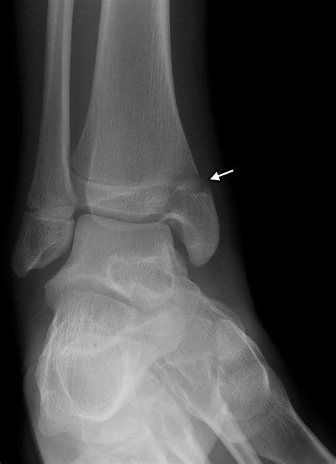 Hairline Fracture X Ray Ankle at Leah Crisp blog