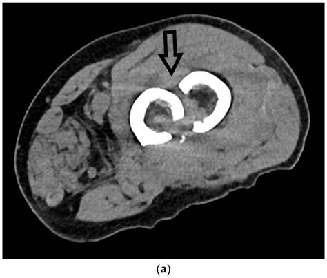 Radiological Diagnosis and Imaging of Femoral Shaft Fractures