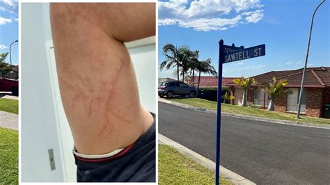 Lightning bolt hits Albion Park man who lives to tell the tale ...