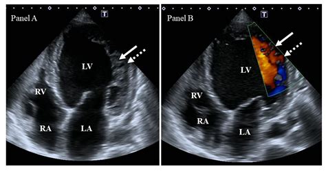 Myocardial Mechanics and Associated Valvular and Vascular Abnormalities ...