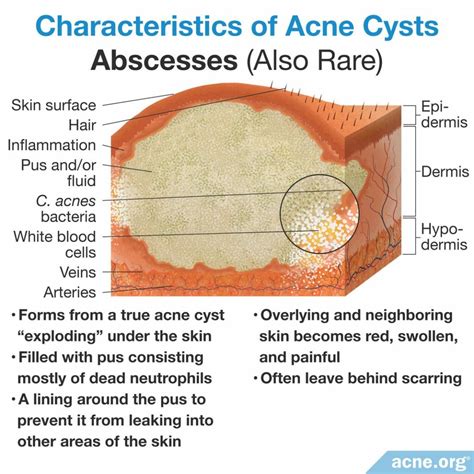 What Is an Acne Cyst? - Acne.org