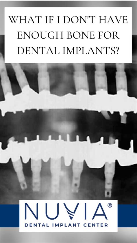 Does Bone Density Affect Dental Implants at Cassandra Edwards blog