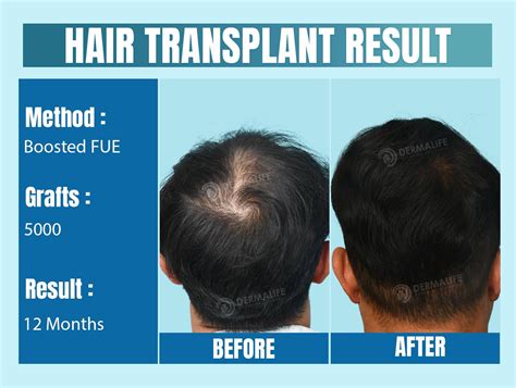 Hair Transplant Before After Result of Crown Area