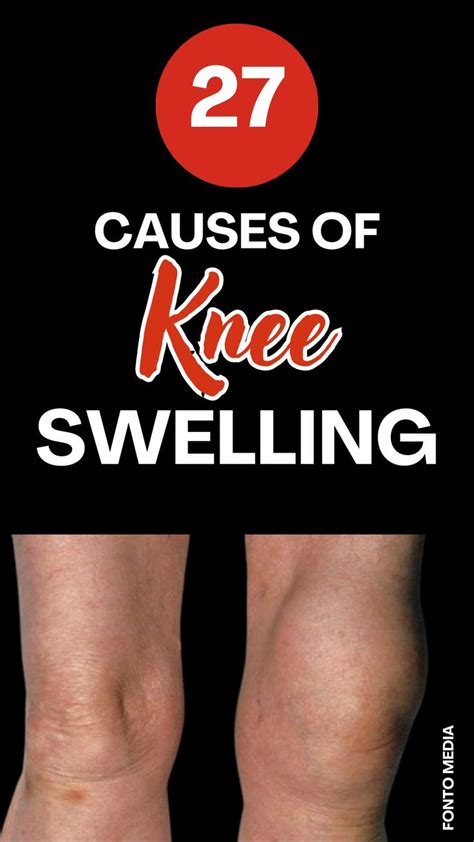 lyme disease knee swelling