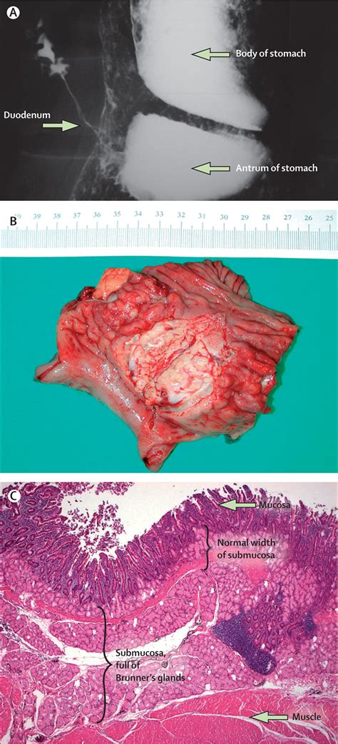 Kuvatulokset haulle brunner syndrome