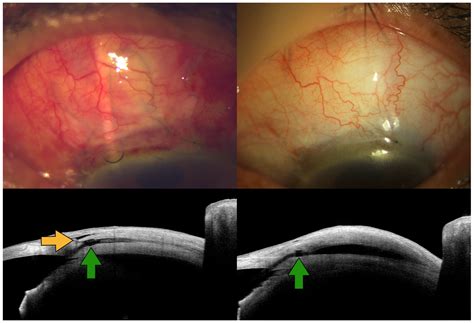 Early Clinical Experience with the Novel A-Stream Glaucoma Shunt ...