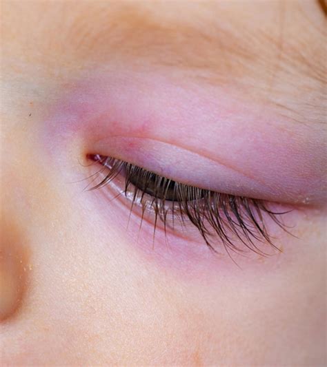 Bug Bite Swollen Eyelid Treatment Fast at Victoria Gregory blog