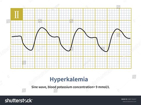 Hyperkalemia Ecg Sine Wave
