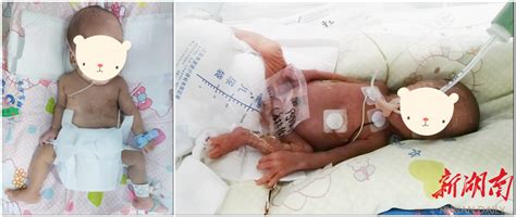 重650克、胎龄26周，长沙市妇幼保健院成功救治超低出生体重双胞胎宝宝 - 健康见闻 - 新湖南
