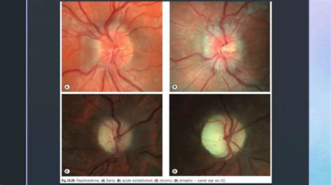 Papilledema - Optic Nerve Head Swelling | PPTX