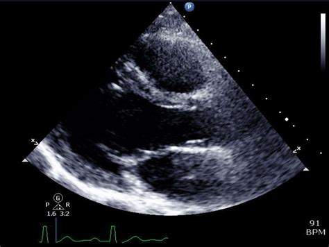 Normal Echocardiogram Results Usefulness Of Pulsed Doppler Tissue
