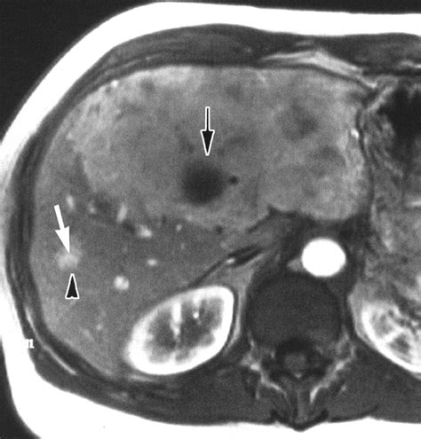 CT and MR Imaging Findings in Focal Nodular Hyperplasia of the Liver Radiologic—Pathologic ...